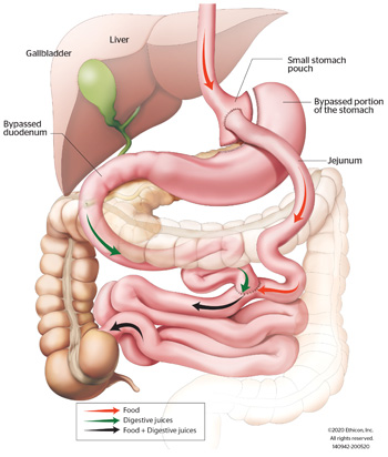 Loop Duodenal Switch