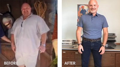 Jeremy, lost 305 pounds with a band to sleeve revision.