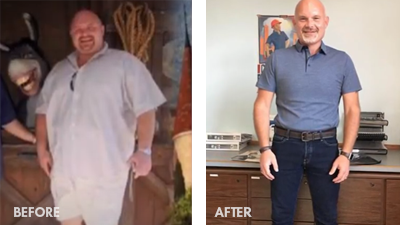 Jeremy, lost 305 pounds with a band to sleeve revision.