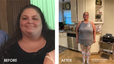 Mandy, lost 111 pounds with a sleeve to bypass revision.
