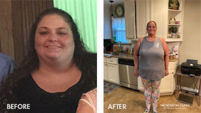 Mandy, lost 111 pounds with a sleeve to bypass revision.