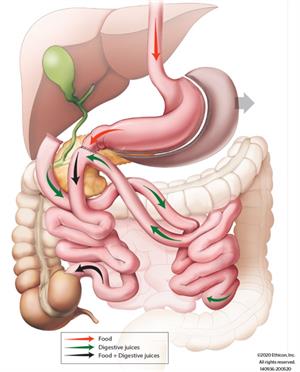 Loop Duodenal Switch