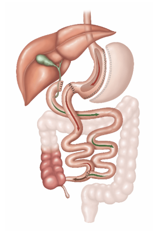 Loop Duodenal Switch